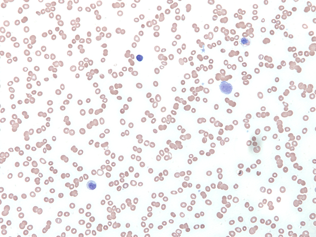 Peripheral blood, Wright Giemsa, 20x. A pancytopenia with moderate anisopoikilocytosis was evident at initial diagnosis.